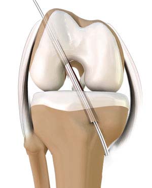 Knee Reconstruction