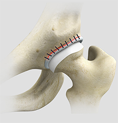 hip reconstruction