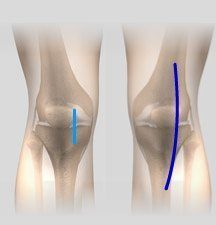 Less Invasive Total Knee Arthroplasty