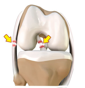 Multiligament Knee Injury