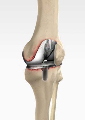 Revision Knee Replacement 