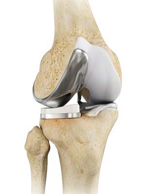 Partial Knee Replacement